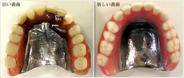 旧い義歯と新しい義歯