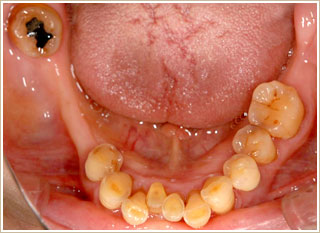 アタッチメント義歯治療前　下顎　別角度