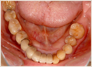 アタッチメント義歯治療後　下顎　別角度