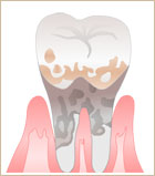 歯周病のイラスト