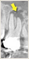 CT写真中、矢印で示す黒い影が根先病巣1