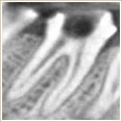 健康な歯周組織のCT画像1