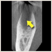 重度の歯周病のCT画像2