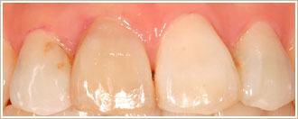 セレックシステム　前歯の治療前の写真