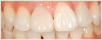 セレックシステム　前歯の治療後の写真