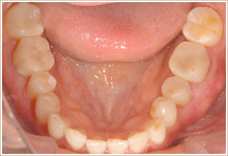 セレックシステム　下顎の治療後の写真