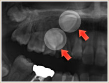変な所から永久小臼歯が萌(は)えてきている個所をCTで撮影した写真