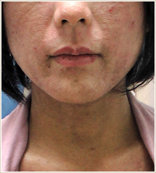 ノンメンタル治療前　顔部分