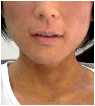 ノンメンタル治療後　顔部分