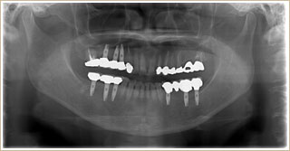 インプラントのレントゲン画像。