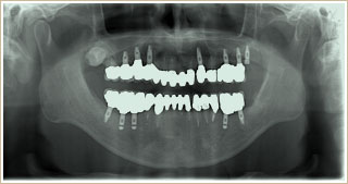 術後パノラマＸ線写真