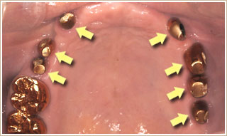 ７本の上顎インプラントに支台部を取り付けたところ