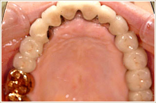 上顎に固定式の冠を装着したところ