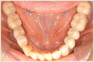 下顎に固定式の冠を装着したところ