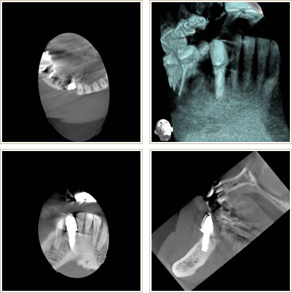 インプラントの治療後のＣＴ写真