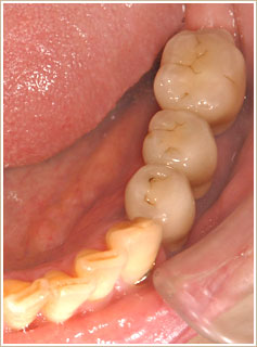 インプラント治療後　下顎写真