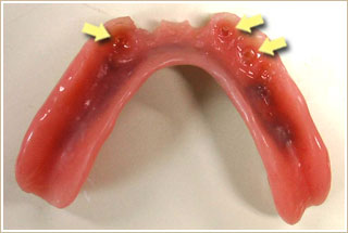 新しい義歯の裏側