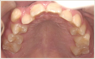 矯正治療前　上顎