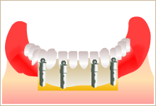 インプラントを土台にして入れ歯を安定させ、動かず、しっかりした義歯にすることができるイラスト