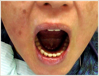 口を大きく開けて義歯の状態がどうなっているか分かる写真