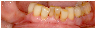 アタッチメント義歯治療前　下顎