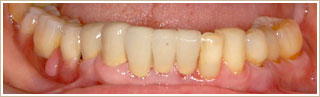 アタッチメント義歯治療後　下顎