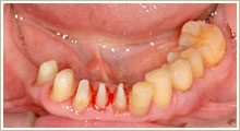むし歯と歯周病の治療を終了した後、アタッチメント装置付きのクラウンをかぶせるために歯をきれいに削った写真