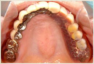 義歯を入れている状態　上顎
