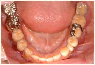 義歯を入れている状態　下顎