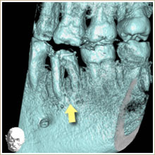 CT写真　歯の状態が悪いことが分かる