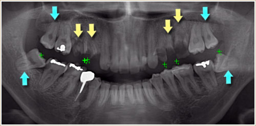 パノラマレントゲン写真　歯牙移植前の確認（移植先は抜去済）
