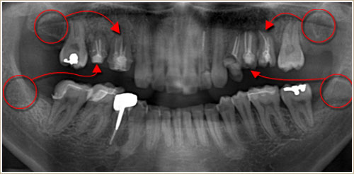 パノラマレントゲン写真　歯牙移植後