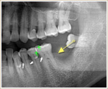 パノラマレントゲン写真　歯を移動する前の状態