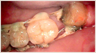歯の移動を開始後3ヶ月の写真