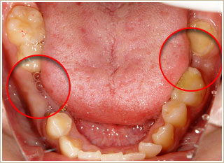 歯とむし歯の処置をした後の写真