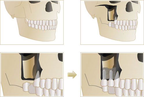 上顎骨の中に上顎洞（サイナス）構造イラスト