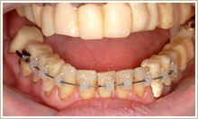 下顎には歯列矯正を行い、期間は3ヶ月で終了