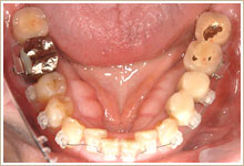 上・下顎には歯列矯正を行い、期間は7ヶ月で終了