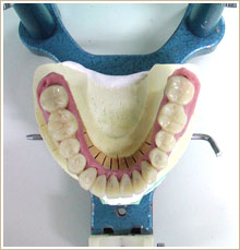 治療用の歯で、適正な噛み合わせになるよう調整していく