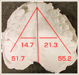 模型による歯列の計測　上顎