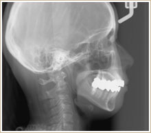 頭蓋骨のレントゲン像　側面