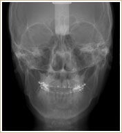 頭蓋骨のレントゲン像　正面