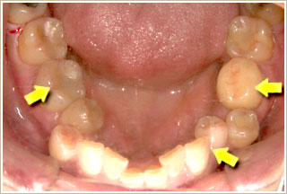 歯列が歪んでいる下顎からの写真　治療前