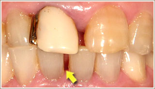 審美補綴治療前　前歯
