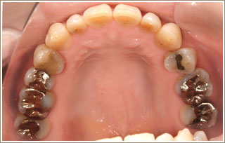 審美補綴治療前　上の奥歯