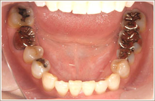 審美補綴治療前　下の奥歯