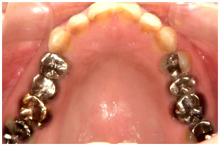 審美補綴治療前　上の奥歯