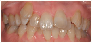 歯列矯正治療前　正面
