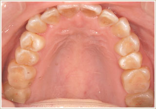 歯列矯正治療後　上顎