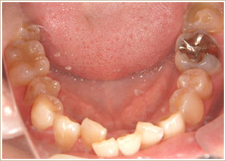 歯列矯正治療前　下顎